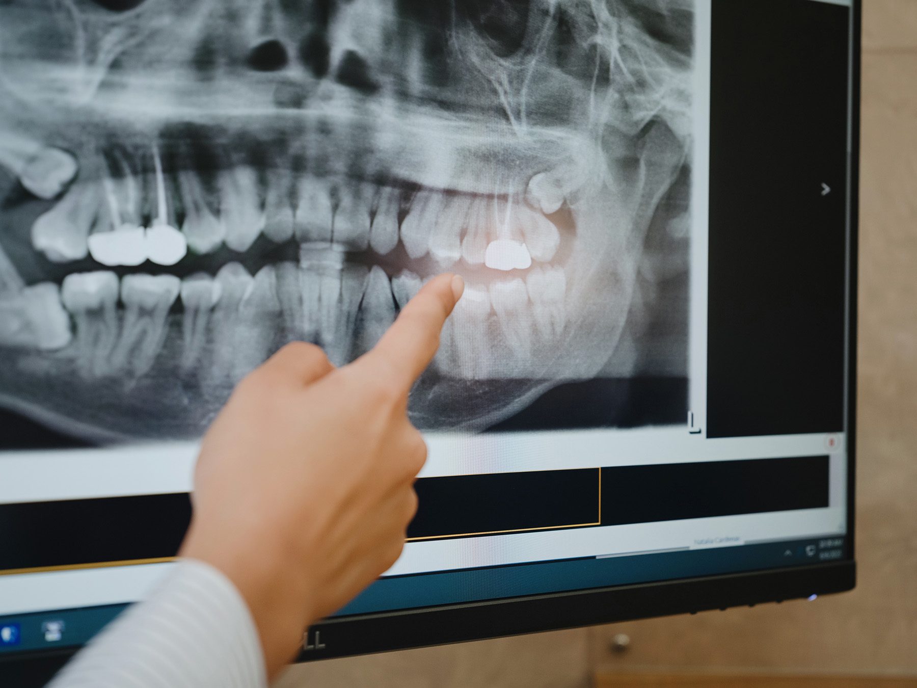 A hand pointing to a panoramic dental X-ray on screen